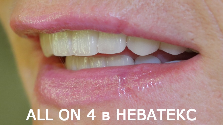 Прекрасный результат восстановления зубов имплантами All on 4 восстановление зубов имплантами all on 4